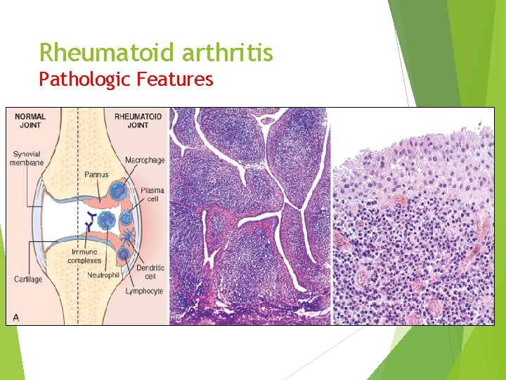 Rheumatoid arthritis Pathologic Features 