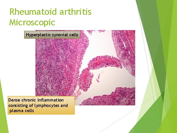 Rheumatoid arthritis Microscopic Hyperplastic synovial cells Dense chronic inflammation consisting of lymphocytes and plasma