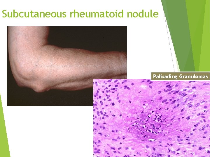 Subcutaneous rheumatoid nodule Palisading Granulomas 