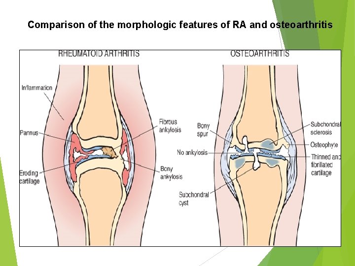 Comparison of the morphologic features of RA and osteoarthritis 
