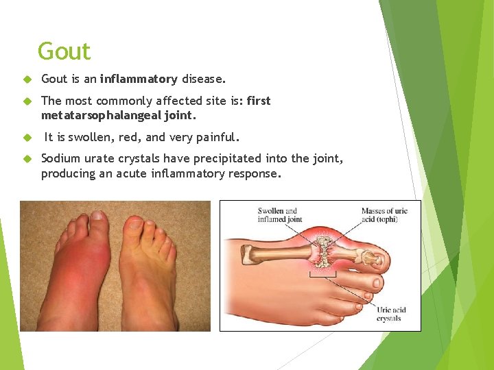 Gout is an inflammatory disease. The most commonly affected site is: first metatarsophalangeal joint.