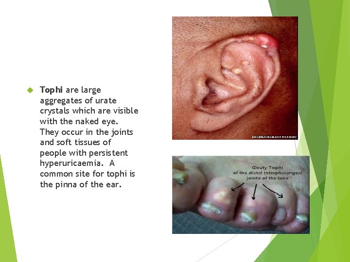  Tophi are large aggregates of urate crystals which are visible with the naked