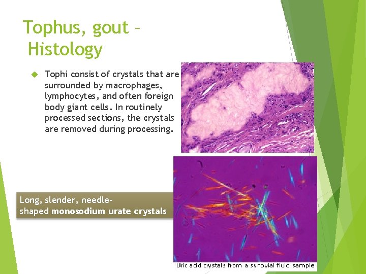 Tophus, gout – Histology Tophi consist of crystals that are surrounded by macrophages, lymphocytes,