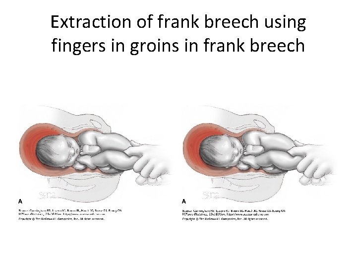 Extraction of frank breech using fingers in groins in frank breech 