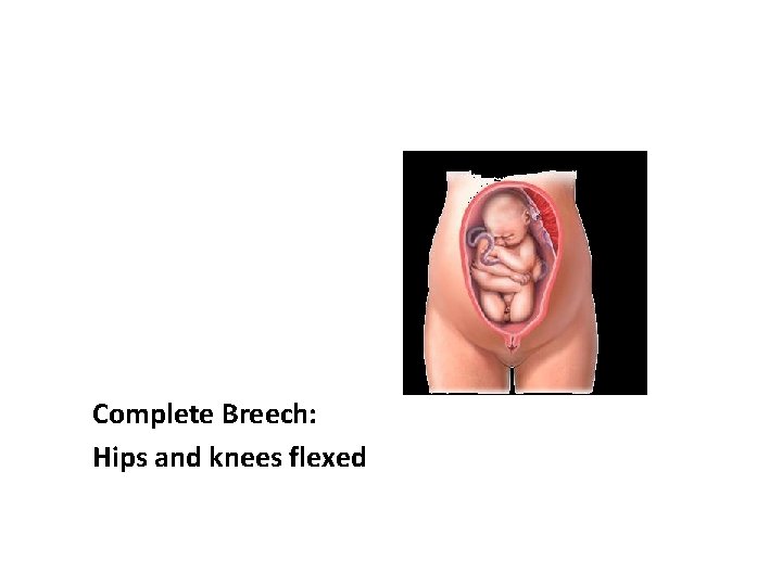 Complete Breech: Hips and knees flexed 
