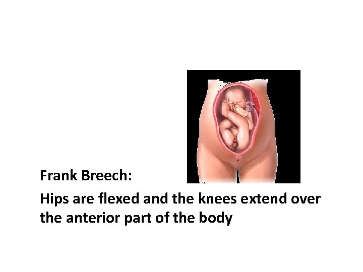 Frank Breech: Hips are flexed and the knees extend over the anterior part of