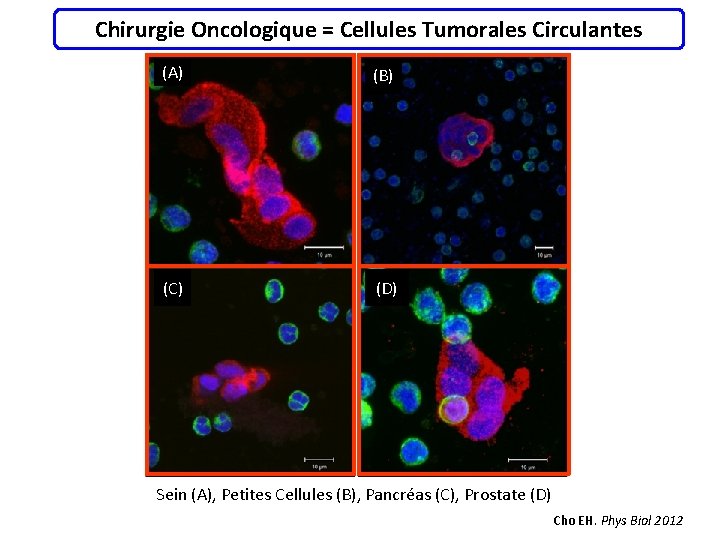 Chirurgie Oncologique = Cellules Tumorales Circulantes (A) (B) (C) (D) Sein (A), Petites Cellules