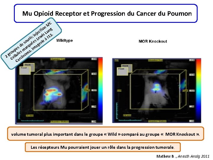 Mu Opioid Receptor et Progression du Cancer du Poumon /C S n tio ung