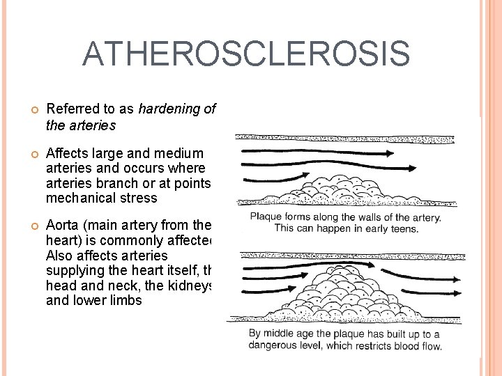 ATHEROSCLEROSIS Referred to as hardening of the arteries Affects large and medium arteries and
