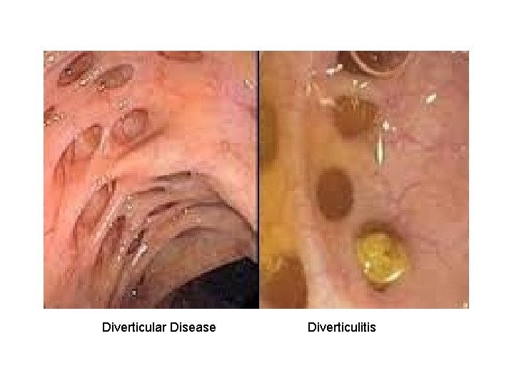 Diverticular Disease Diverticulitis 
