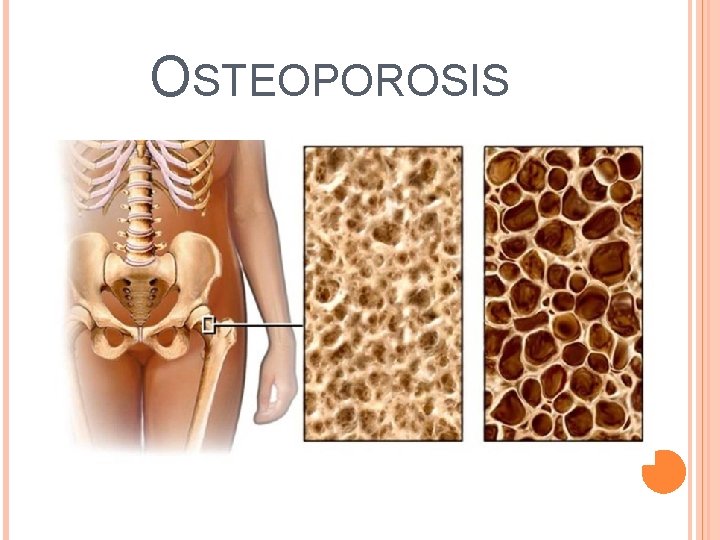 OSTEOPOROSIS 