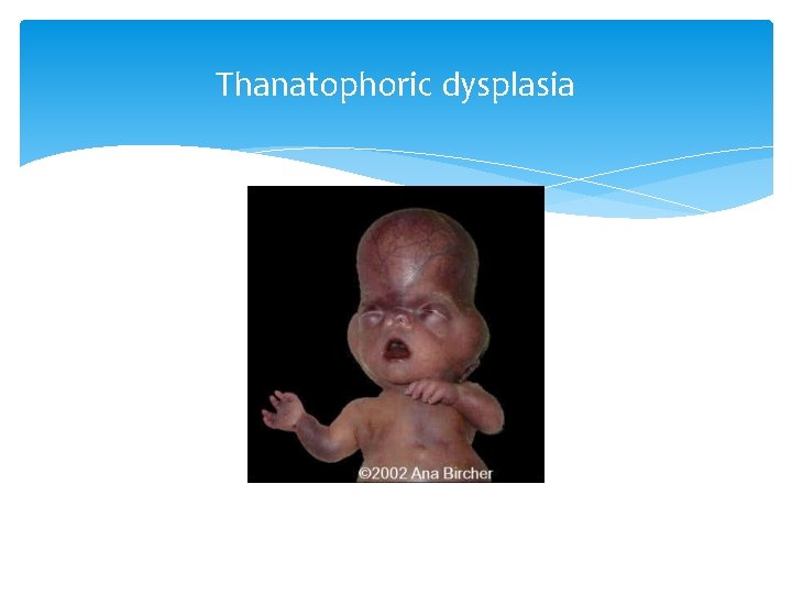 Thanatophoric dysplasia 