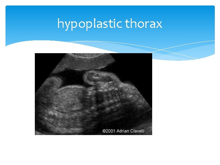 hypoplastic thorax 