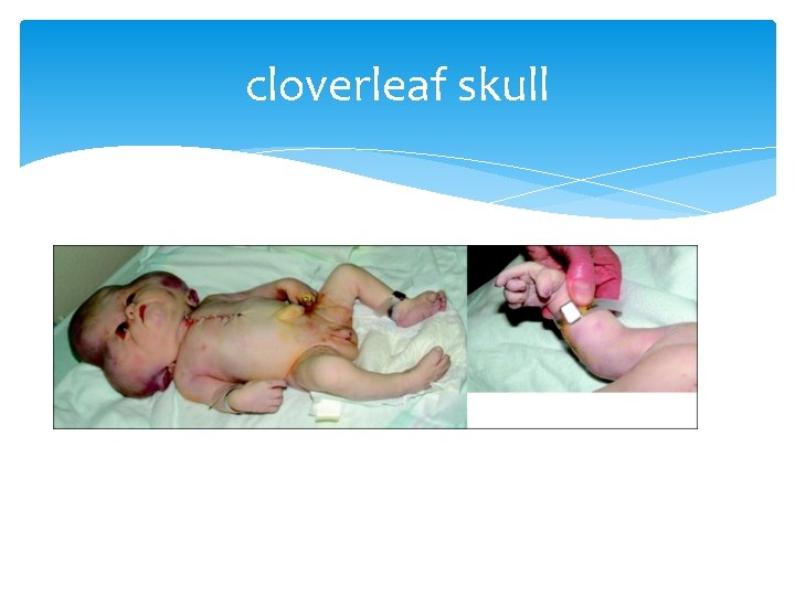 cloverleaf skull 