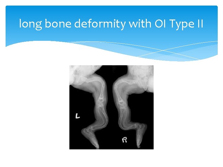 long bone deformity with OI Type II 