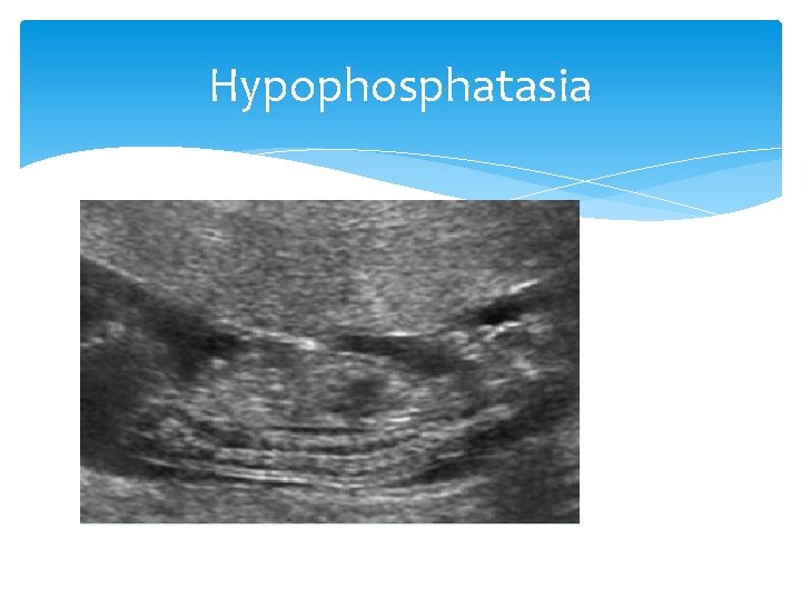 Hypophosphatasia 