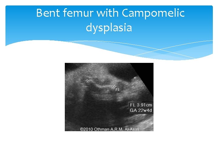 Bent femur with Campomelic dysplasia 
