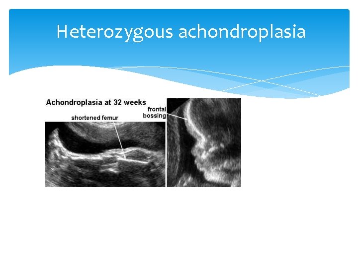 Heterozygous achondroplasia 