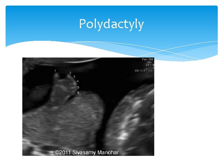 Polydactyly 