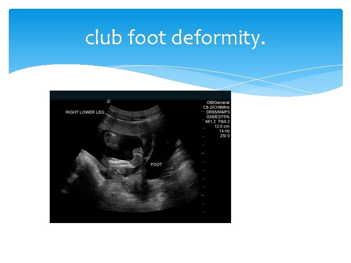 club foot deformity. 