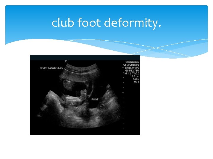 club foot deformity. 