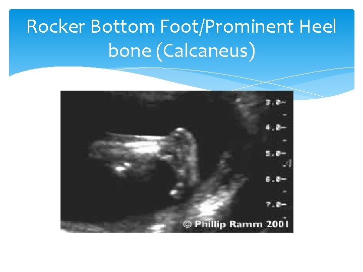 Rocker Bottom Foot/Prominent Heel bone (Calcaneus) 