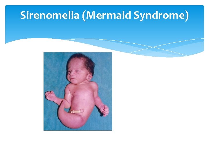 Sirenomelia (Mermaid Syndrome) 