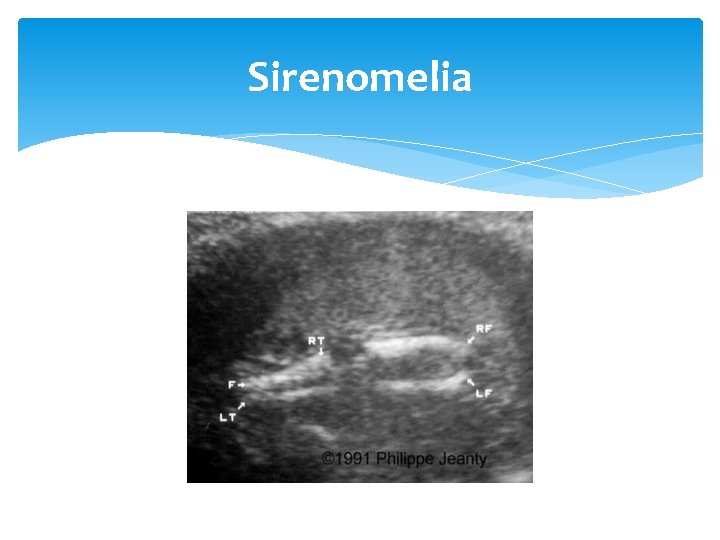 Sirenomelia 