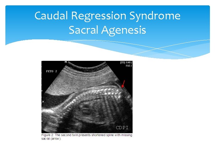 Caudal Regression Syndrome Sacral Agenesis 