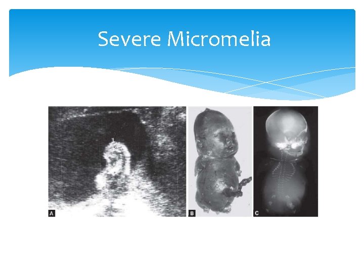 Severe Micromelia 