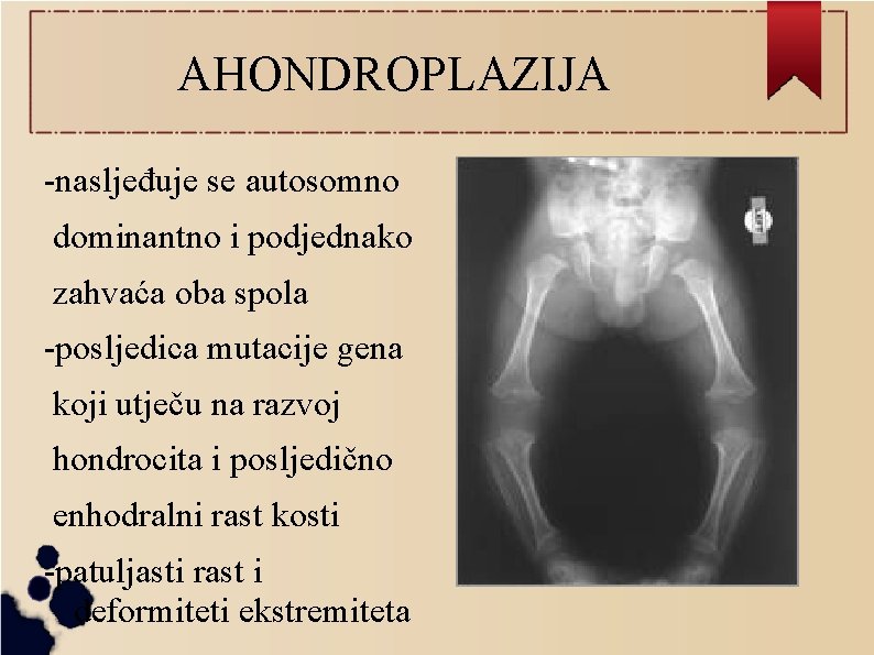 AHONDROPLAZIJA -nasljeđuje se autosomno dominantno i podjednako zahvaća oba spola -posljedica mutacije gena koji