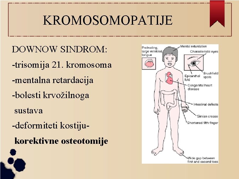 KROMOSOMOPATIJE DOWNOW SINDROM: -trisomija 21. kromosoma -mentalna retardacija -bolesti krvožilnoga sustava -deformiteti kostijukorektivne osteotomije