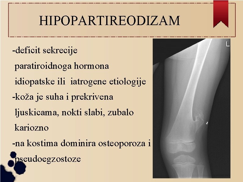 HIPOPARTIREODIZAM -deficit sekrecije paratiroidnoga hormona idiopatske ili iatrogene etiologije -koža je suha i prekrivena