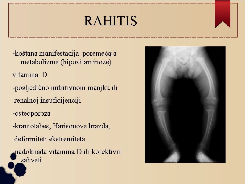 RAHITIS -koštana manifestacija poremećaja metabolizma (hipovitaminoze) vitamina D -posljedično nutritivnom manjku ili renalnoj insuficijenciji