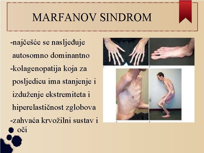 MARFANOV SINDROM -najčešće se nasljeđuje autosomno dominantno -kolagenopatija koja za posljedicu ima stanjenje i