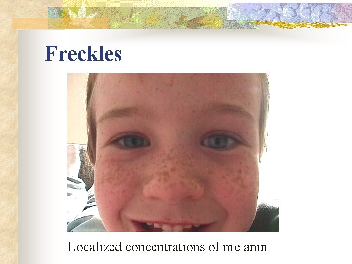 Freckles Localized concentrations of melanin 