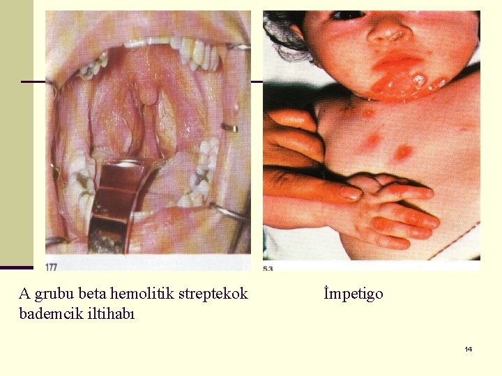 A grubu beta hemolitik streptekok bademcik iltihabı İmpetigo 14 