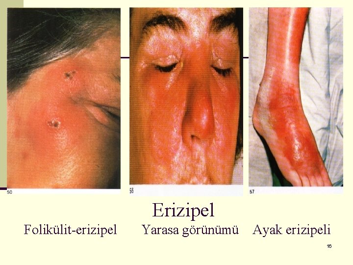 Erizipel Folikülit-erizipel Yarasa görünümü Ayak erizipeli 16 