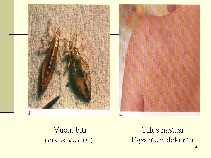 Vücut biti (erkek ve dişi) Tifüs hastası Egzantem döküntü 21 