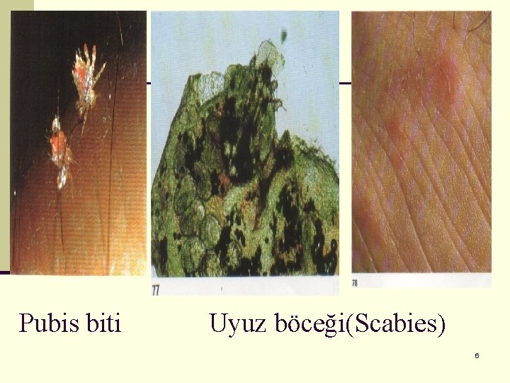 Pubis biti Uyuz böceği(Scabies) 6 