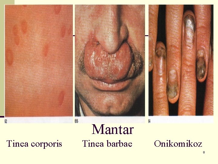 Mantar Tinea corporis Tinea barbae Onikomikoz 8 