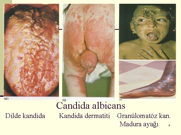Candida albicans Dilde kandida Kandida dermatiti Granülomatöz kan. Madura ayağı 9 