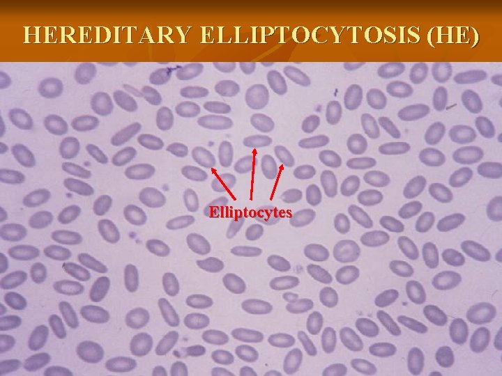 HEREDITARY ELLIPTOCYTOSIS (HE) Elliptocytes 