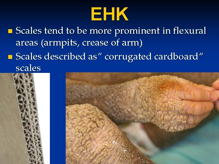EHK Scales tend to be more prominent in flexural areas (armpits, crease of arm) EHK Scales tend to be more prominent in flexural areas (armpits, crease of arm)