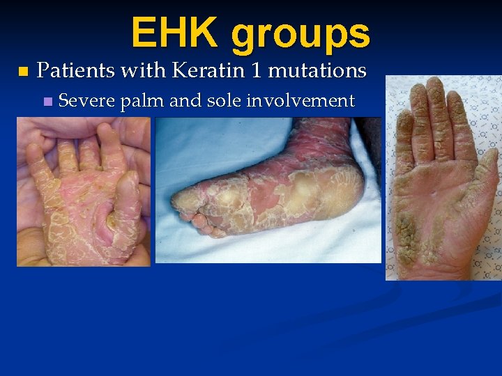 EHK groups n Patients with Keratin 1 mutations n Severe palm and sole involvement EHK groups n Patients with Keratin 1 mutations n Severe palm and sole involvement
