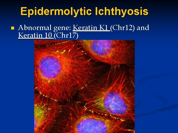 Epidermolytic Ichthyosis n Abnormal gene: Keratin K 1 (Chr 12) and Keratin 10 (Chr Epidermolytic Ichthyosis n Abnormal gene: Keratin K 1 (Chr 12) and Keratin 10 (Chr