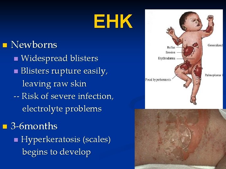 EHK n Newborns Widespread blisters n Blisters rupture easily, leaving raw skin -- Risk EHK n Newborns Widespread blisters n Blisters rupture easily, leaving raw skin -- Risk