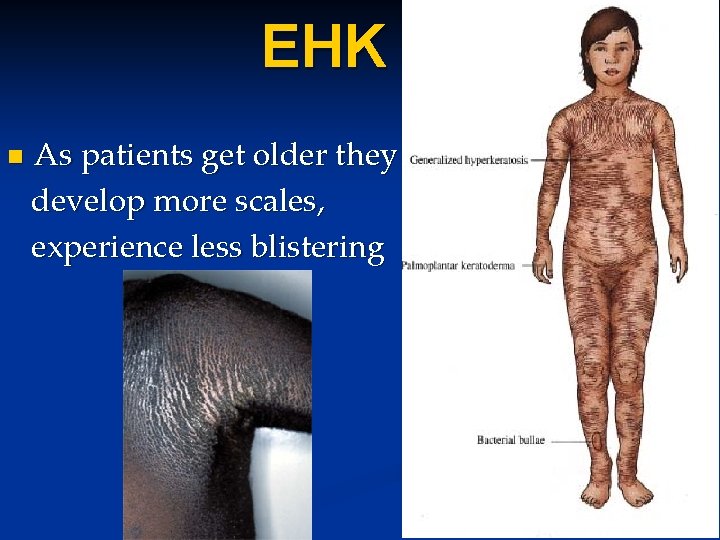 EHK n As patients get older they develop more scales, experience less blistering EHK n As patients get older they develop more scales, experience less blistering