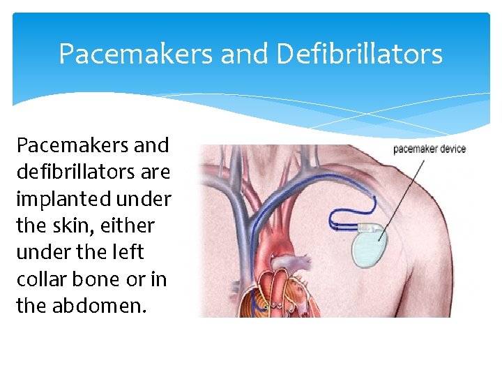 Pacemakers and Defibrillators Pacemakers and defibrillators are implanted under the skin, either under the