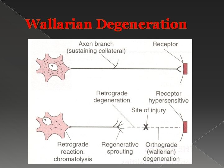 Wallarian Degeneration 